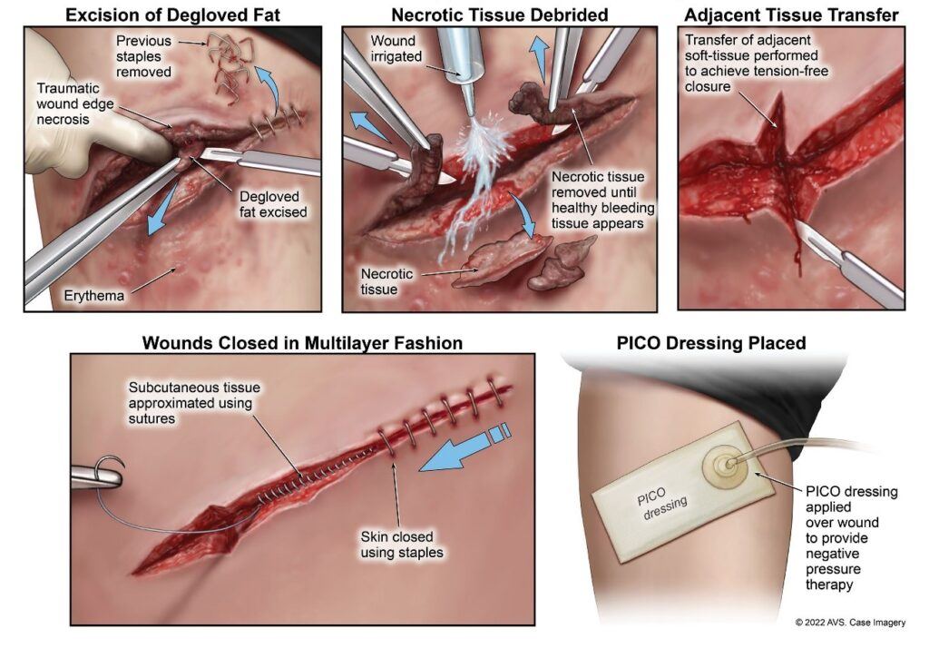 Mr. Ramos’ second surgery to repair his large leg wound