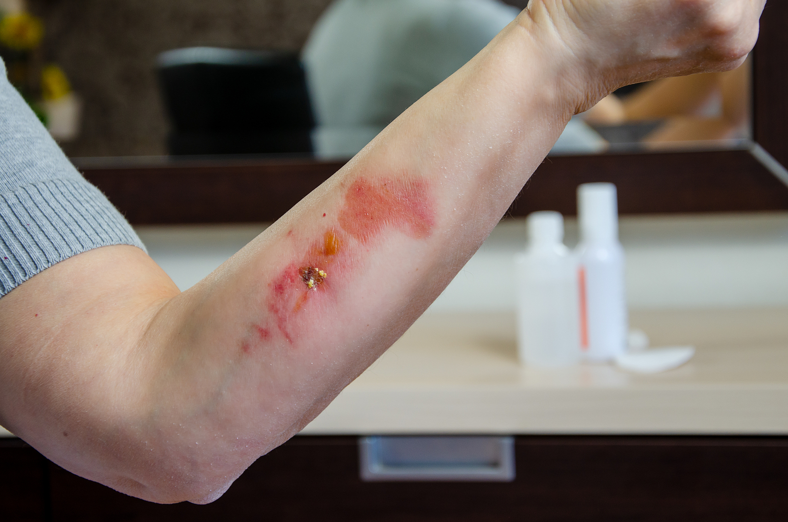 Jonesboro Burn Injury Lawyer