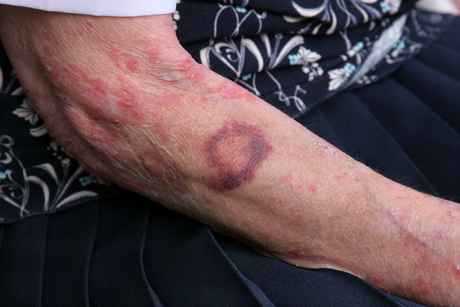 Lawrenceville Georgia Elder Abuse Lawyer
