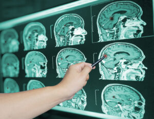 Traumatic Brain Injury After a Motorcycle Accident